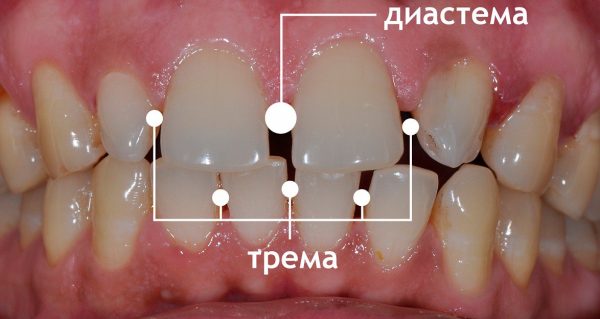 Как помогают брекеты при диастеме Как помогают брекеты при диастеме